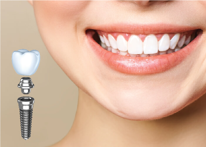 Phải mất bao lâu để cấy ghép implant phụ thuộc vào những yếu tố nào?