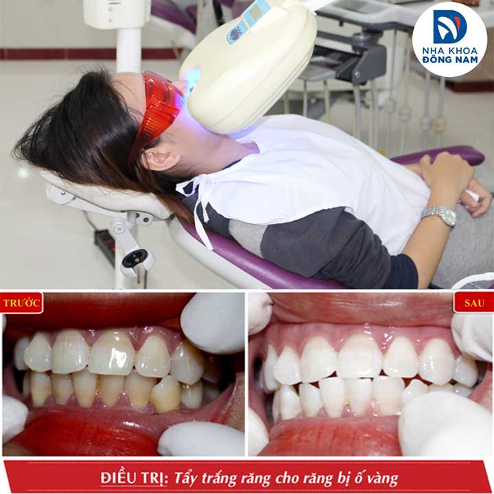 Top 10 địa chỉ tẩy trắng răng uy tín tại TP.HCM