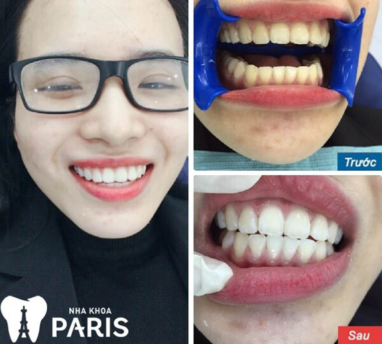 Top 10 địa chỉ tẩy trắng răng uy tín tại Thành phố Hồ Chí Minh